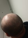 Been shaving head since 26. Let it grow for 2 weeks just to see. Is there even a point to consulting a hair loss specialist at this point? If not then I&rsquo;ll keep shaving,