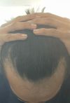 Seeking Advice on Switching Treatments After Minoxidil and Finpecia