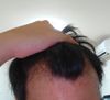 [29M] Living in Japan. Need advice on transitioning Finasteride brands, sourcing options, adding Minoxidil, and managing chronic scalp inflammation/burning