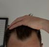 38M Seeking Advice on Minoxidil/Finasteride and Hair Transplants
