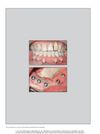 Vestibuloplasty With Retroauricular Skin Grafts For Dental Implant Rehabilitation In Vascularized Fibula Grafts: Two Case Reports