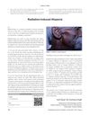 Radiation-Induced Alopecia