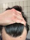 24M with mild temple recession - is topical finasteride worth it?