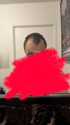 Should I Start Finasteride and Minoxidil with Minimal Hair Loss and Mental Health Concerns?