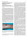 Localized Primary Cutaneous Nodular Amyloidosis in a Patient With Paraproteinemia