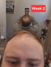 My hair regrowth journey