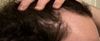 19M on HRT Concerned About Hairline Receding; Finasteride Concerns