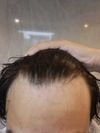 Exploring Alternatives to Minoxidil and Finasteride at 17