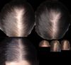 25M with Seb Derm and Thinning: Seeking Severity Assessment and Advice