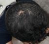 23M on 0.25mg Finasteride for 7 Weeks: Increased Shedding, Change Dose?