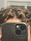 Oral Fin/min 1 year – diffuse thinning or parting hairline too much?