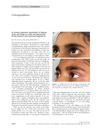 An Unusual Anatomical Colocalization of Alopecia Areata and Vitiligo in a Child, and Improvement During Treatment with Topical Prostaglandin E2