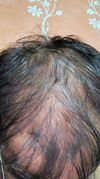 Seeking Advice on Thinning Hair and Treatment Options