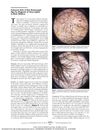 Corkscrew Hair: A New Dermoscopic Sign for Diagnosis of Tinea Capitis in Black Children