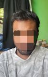 21M Concerned About Temple Recession: Minoxidil/Finasteride Worth It?