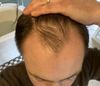 39yo long time receder - Dut/Min progress. Am I right to be excited!?