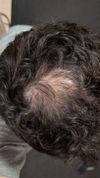 How many grafts do you think? Will they be able to HT on to the scalp since it&rsquo;s not gone fully? Been on min/fin/stamp for a year, little effect for me
