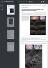 Line-Field Confocal Optical Coherence Tomography: A New Diagnostic Method of Lichen Planopilaris