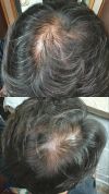 24M with crown thinning and oily scalp - shampoo recommendations and whether to start minoxidil again?