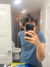 Front Scalp Thinning Despite Using 1mg Fin &amp; 2.5mg Min: AGA or Other Cause?