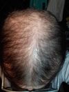 30M Experiencing Shedding After Restarting Min + Fin + Mesotherapy, Is It Too Late?