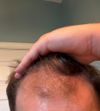 (M25) 10 months on oral min/fin, no growth. Need advice