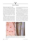 Alopecia Areata Incognita: True or False?