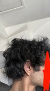 24M: No Hair Regrowth on Dutasteride and Minoxidil After One Year
