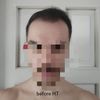 Smp density or 2nd hair transplant?