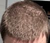 40-Day Oral Minoxidil Results After 2 Years on Finasteride, Is Growth From Minoxidil?