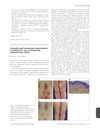Successful Rapid Subcutaneous Desensitization to Anakinra in a Case of Delayed-Type Hypersensitivity Reaction