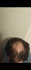 Some progress pics, 26M, on oral Min (4mg), Dut (0.5mg) and biotin (4mg) almost 5 months in