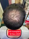 7 month crown transplant progress update | minoxidil since Jan, finasteride since June