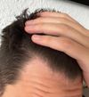 Receding hairline / temples - asking for advice