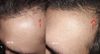 26M - 1mg Finasterida, 2.5mg minoxidil both oral - 2 months