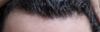 16-Year-Old Considering Minoxidil for Temple and Crown Hair Loss Without Fin