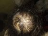 26M with Bald Spot Behind Head, Seeking Regrowth Advice - No Treatment History