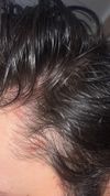 Recent Scalp Itching and Redness, Using Tea Tree/Rosemary Oil, Advice?