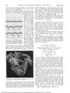 Thallium Poisoning
