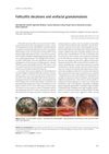 Folliculitis Decalvans and Orofacial Granulomatosis