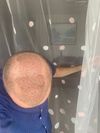 I had 4 DHI hair transplants from 2021 -2025. The last one was on August 15th. Why isn’t my hair thickening? I’ve tried all kinds of pills, including finsteride minoxodil, and why isn’t anything working