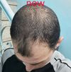 20M - 1 Year on Minoxidil &amp; Dutasteride 6 Months: Am I Seeing Results or Wasting Money?
