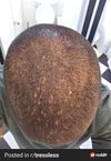 What hair loss pattern is this?