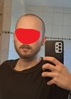Struggling with Balding at 21: Seeking Advice on Implants and Self-Image