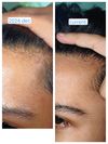 Concerned About Hairline Regression After 2 Years on Finasteride