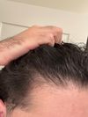 29M, Noticing More Scalp Visibility After 3 Years of Hair Shedding