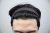 My 12 month Korea Hair Transplant Progress Update