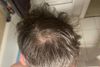 Do I need to cut/shave my hair for effective microneedling on the vertex?