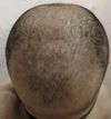 Considering Switch from Topical to Oral Finasteride After 3 Years