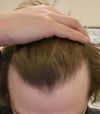 Dutasteride left me in the dark, need help